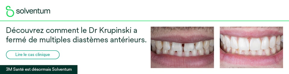 Résultat avant/après la fermeture esthétique de multiples diastèmes